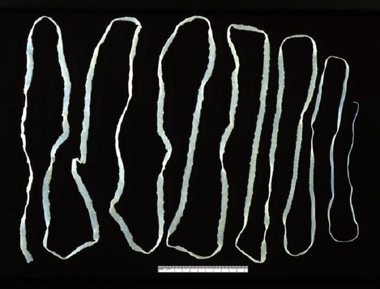 Cacing pita diekstrak daripada usus manusia