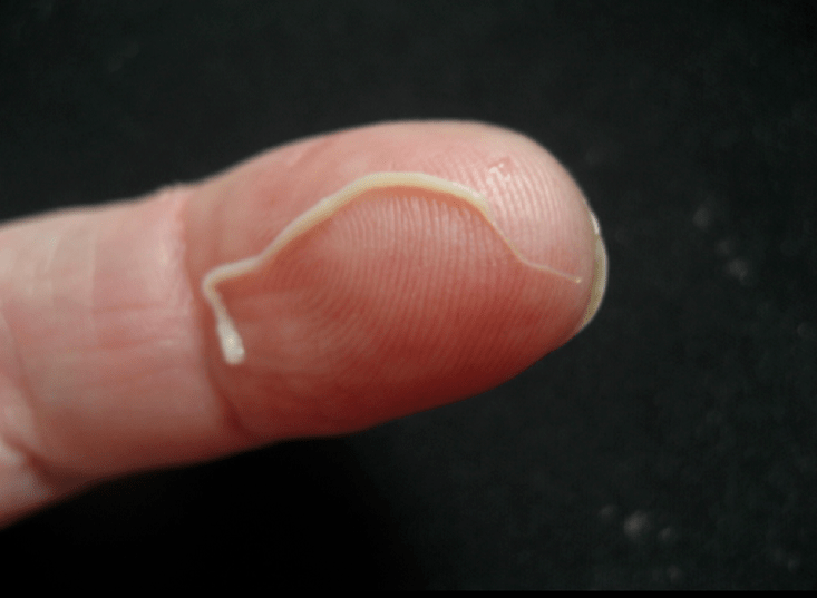 parasit cacing bulat dari tubuh manusia